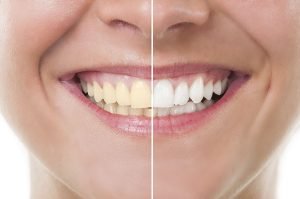 4 Ways to Go From Yellow to Perfect White Teeth