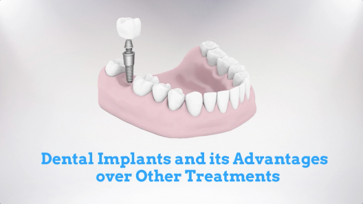 Dental Implants and its Advantages over Other Treatments
