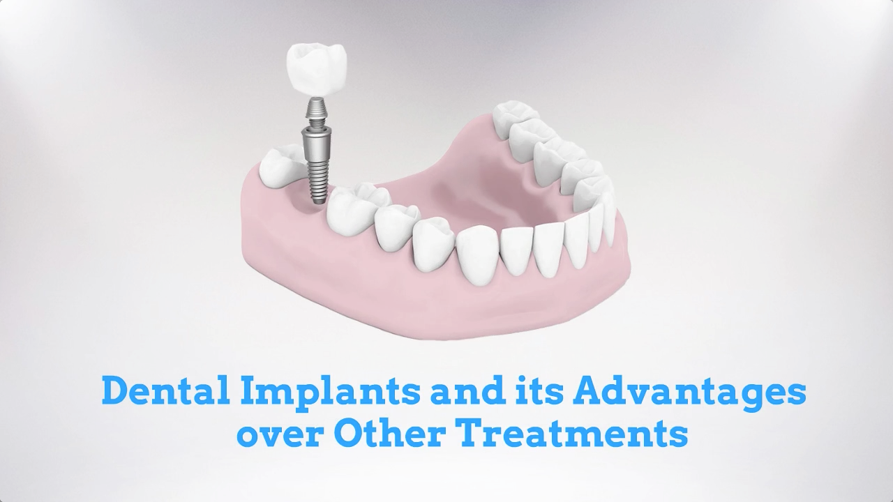Dental Implants and its Advantages over Other Treatments