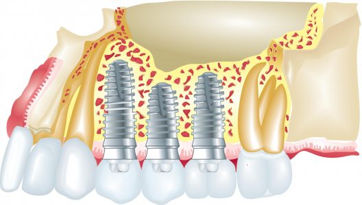 Mernda Dentist Trivia Top 5 Myths about Dental Implants