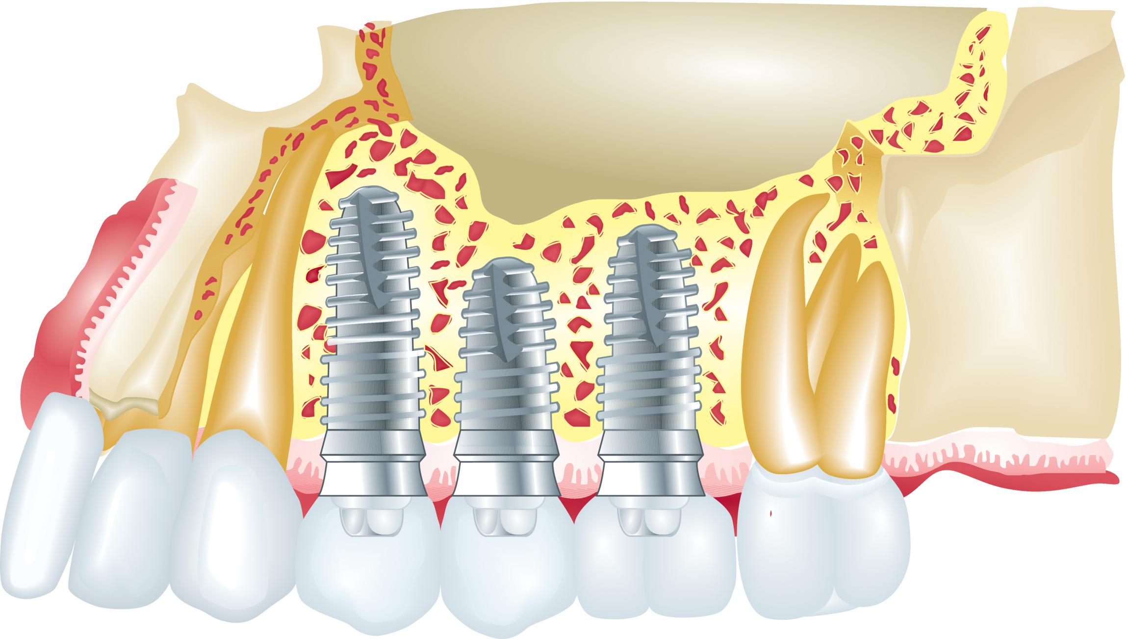 Mernda Dentist Trivia Top 5 Myths about Dental Implants