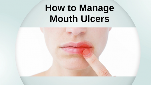 how-to-manage-mouth-ulcers