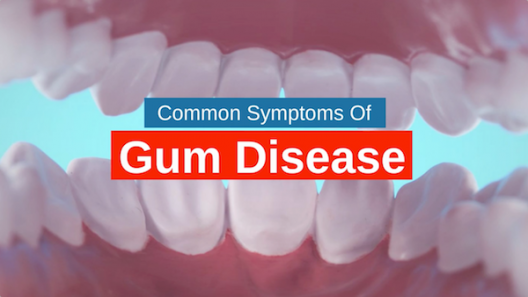 common-symptoms-of-gum-disease